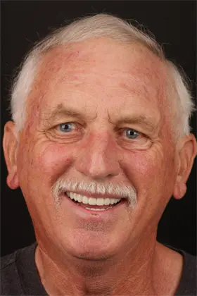 Full-arch smile restored with All-on-4 implants, radiating confidence and happiness.